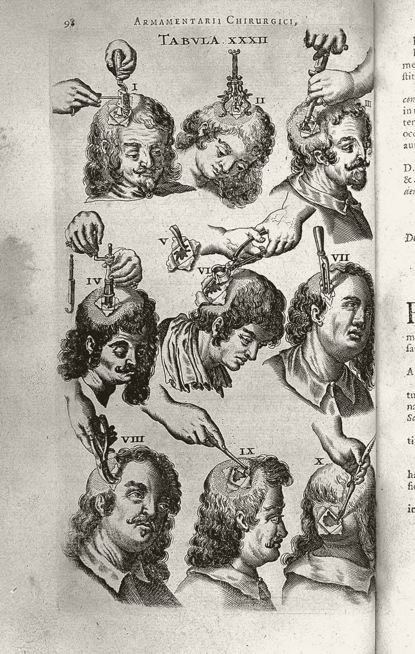 Johannes Scultetus, Armamentarium chirurgicum (1657), tabule XXXII: operace na hlavě. Wellcome Collection, CC BY 4.0; tónováno.